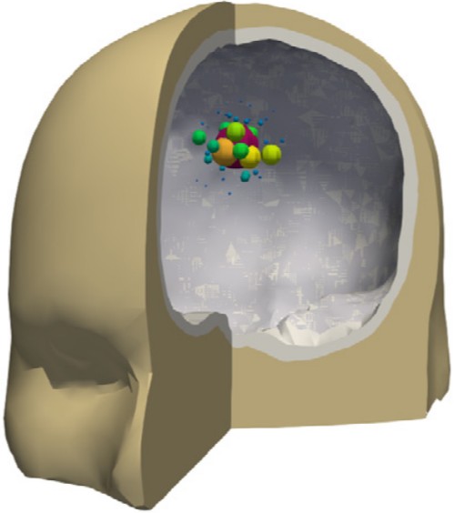 Rekonstruierte epileptogene Quellen.